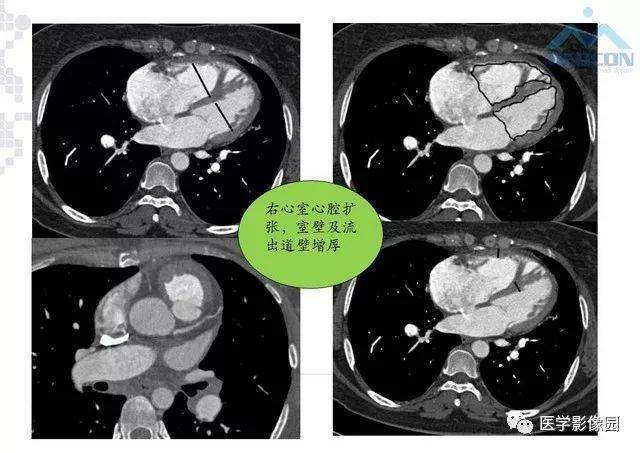 肺动脉高压放射影像学诊断与评价 | 影像天地