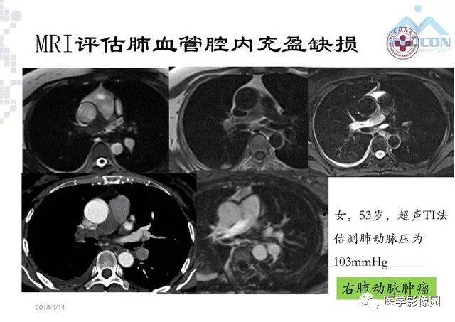 肺动脉高压放射影像学诊断与评价 | 影像天地