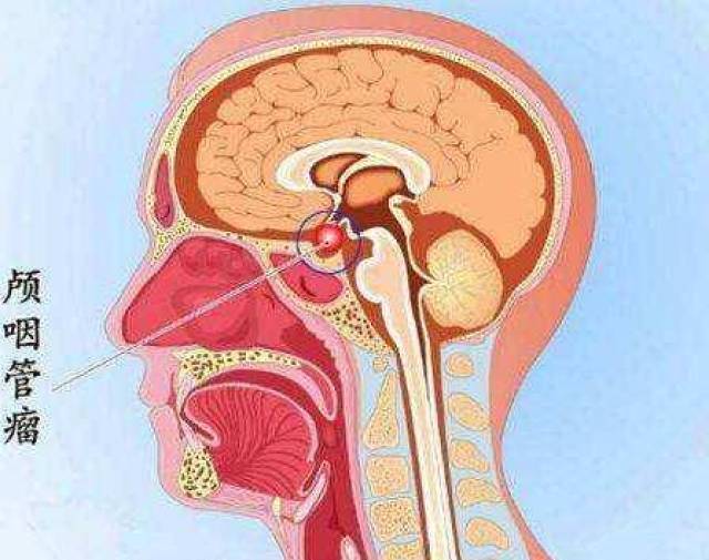 颅咽管瘤危害多,小儿成人都受累