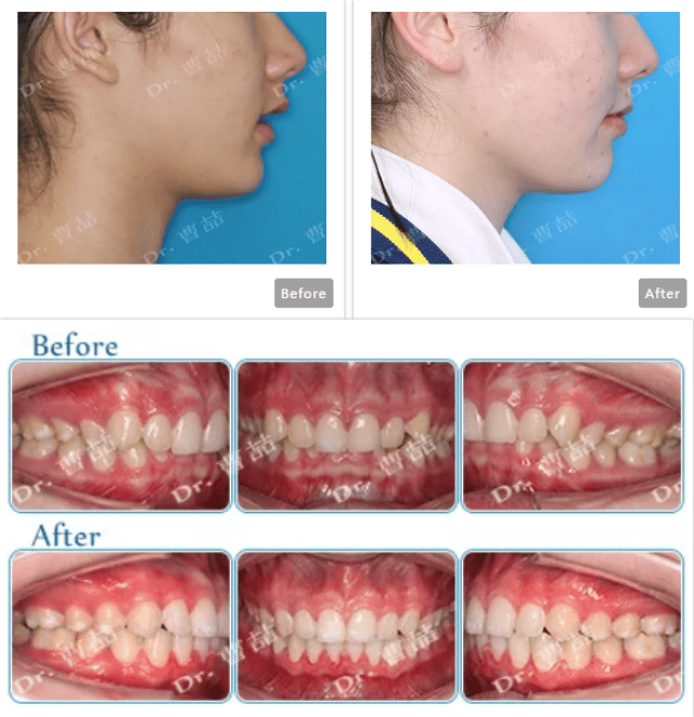 恢复牙齿正常咬合,并通过牙齿内收改善面部比例.