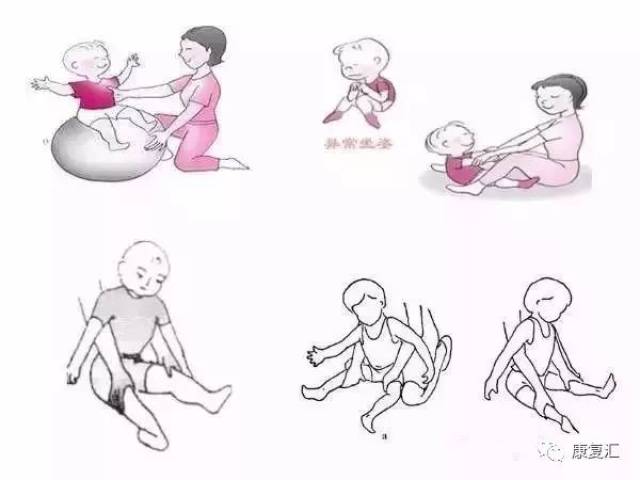 【脑瘫康复】儿童脑瘫训练图文版:从抬头训练到行走训练!