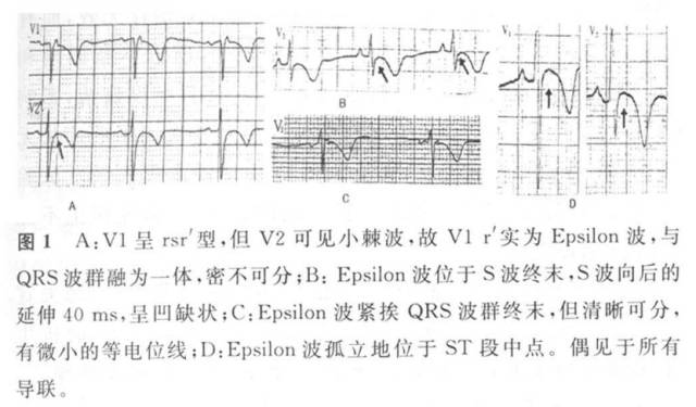 epsilon波——不止是arvc,别忘了这些疾病