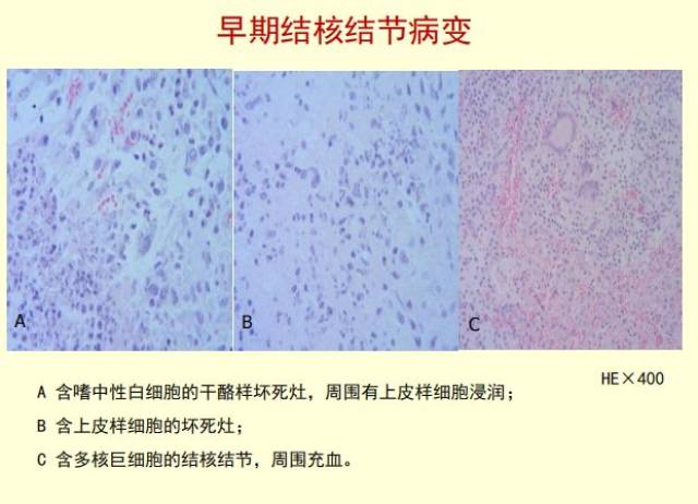 【防控专题】牛结核病环境抵抗体,传播途径,临床症状及病理变化解析