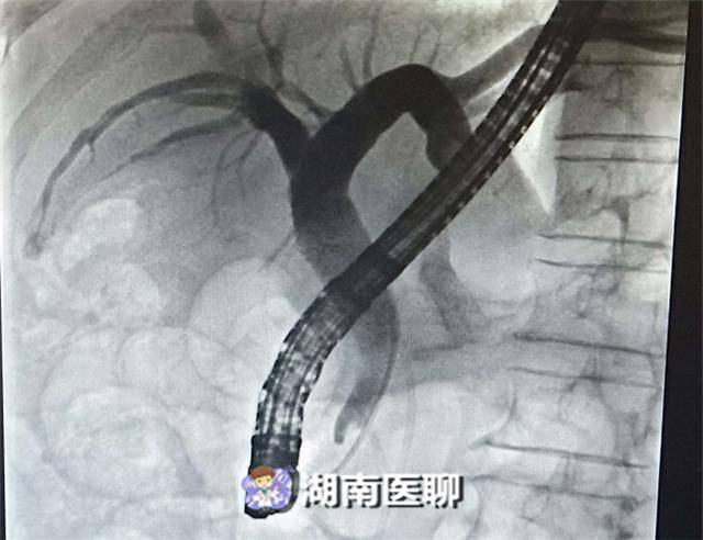 经内镜逆行性胰胆管造影术(ercp)是指将十二指肠镜插至十二指肠降部