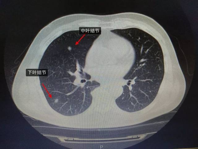 患者为老年男性,查体发现肺内多发结节3年,既往高血压20余年,冠心病