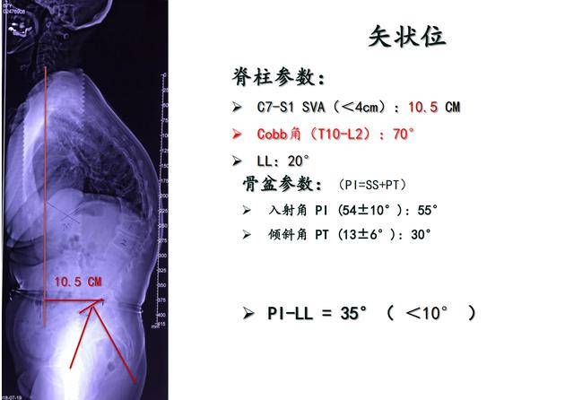 病例分享胸腰段脊柱后凸畸形