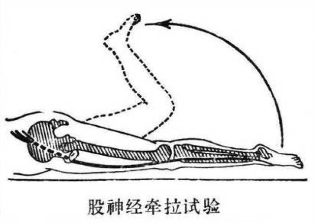 股神经牵拉试验:患者俯卧位,髋和膝关节完全伸直,将下肢抬起使髋关节
