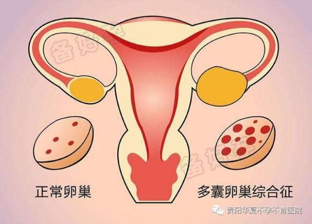 c,多囊卵巢综合症患者 治疗后能怀孕