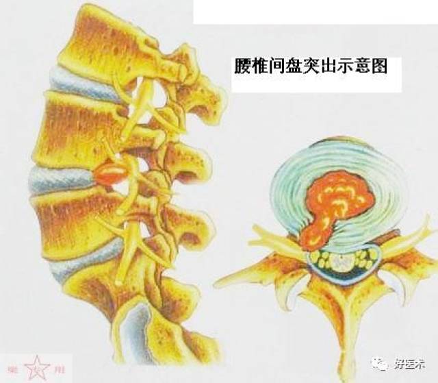 骶1神经根发自腰5/骶1椎间盘的上缘或腰5椎体下1/3水平,向下外走行