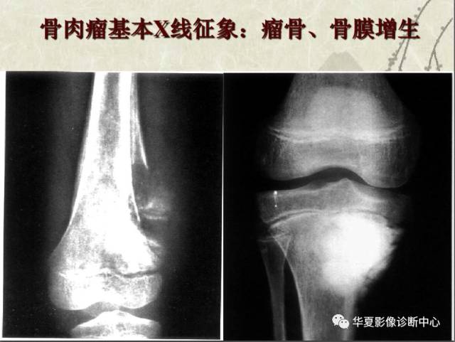 管状骨良恶性骨肿瘤的鉴别诊断