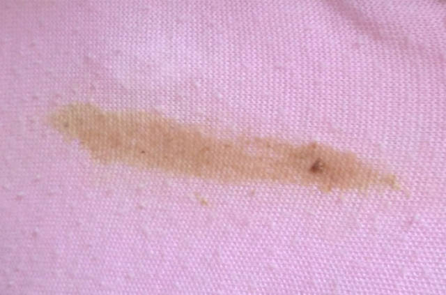 一些妇科病在艾灸过程中会出现阴道不规律出血,分泌物多,出现褐色