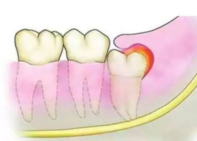 智齿不是你想拔就能拔!医生提醒:3类人别轻易拔!
