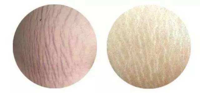 皮肤管理 | 关于橘皮纹的知识全在这里了,5大误区你知道哪一个?