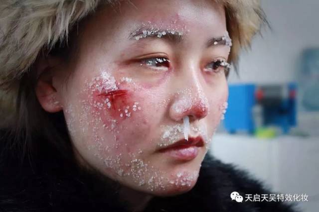 来给小伙伴们看看不同等级的冻伤是什么样子的 " 满脸冰雪,脸部冻红