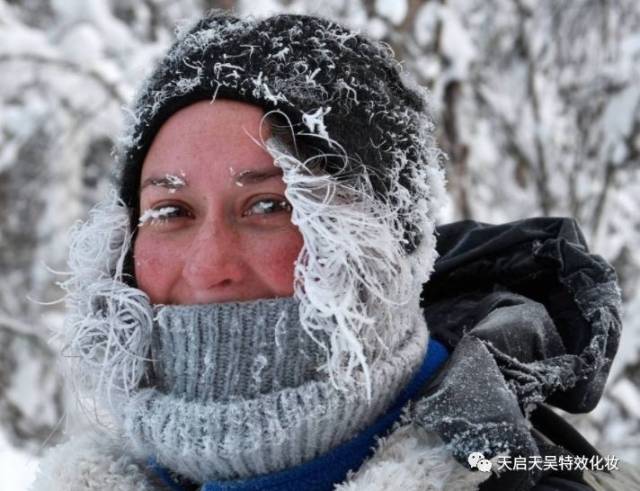 来给小伙伴们看看不同等级的冻伤是什么样子的 " 满脸冰雪,脸部冻红 "