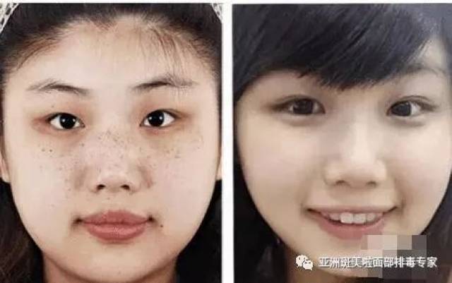 芳芳表姐雀斑治疗前后