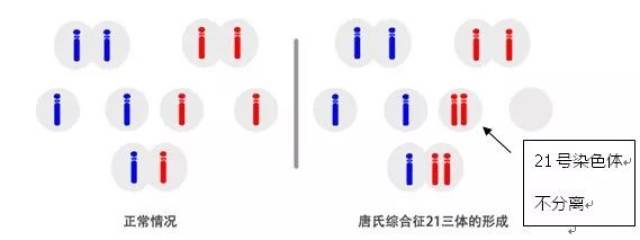 唐氏儿为先天愚型,是由21号常染色体异常造成的,又称21三体综合征