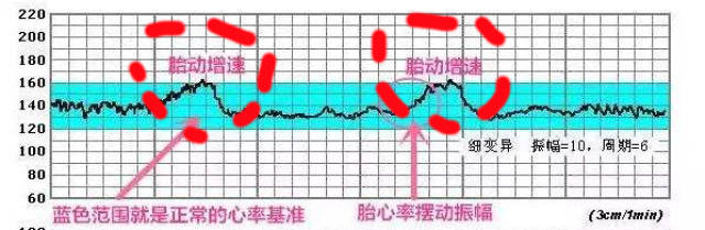 胎儿监护:胎心监护报告解读之胎心率曲线值该如何看?