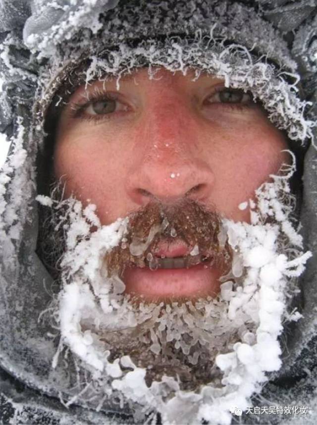 来给小伙伴们看看不同等级的冻伤是什么样子的 满脸冰雪,脸部冻红"