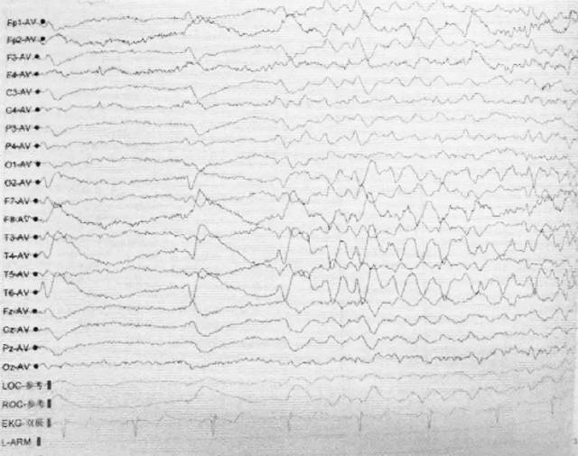 患者脑电图检查结果示右侧前额,额,中颞及后颞单发尖慢波