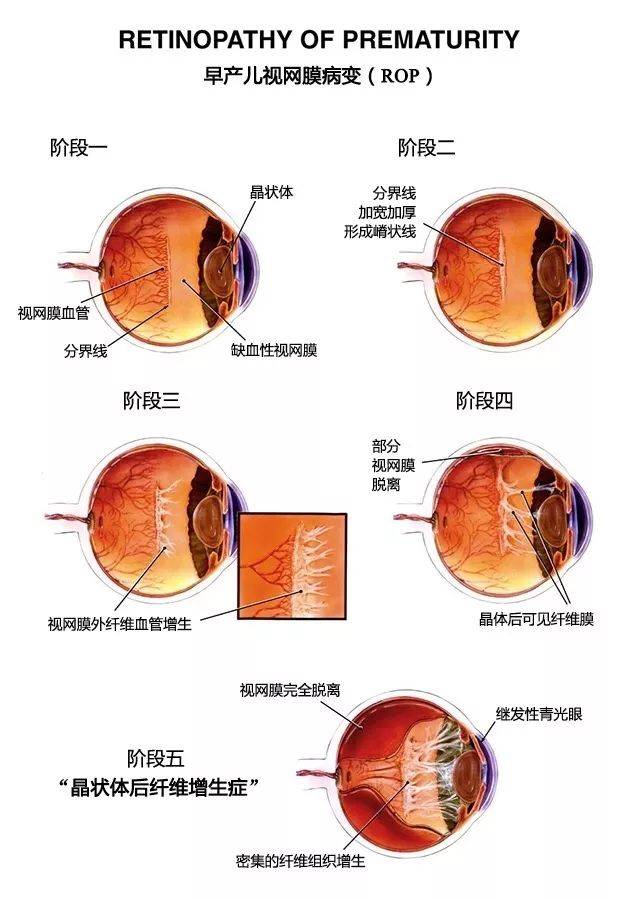 新生儿眼底筛查:宝宝的第一份珍贵礼物