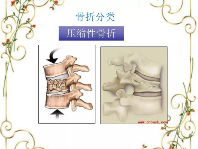 优秀护理查房 ptt -- 腰椎骨折术后护理查房