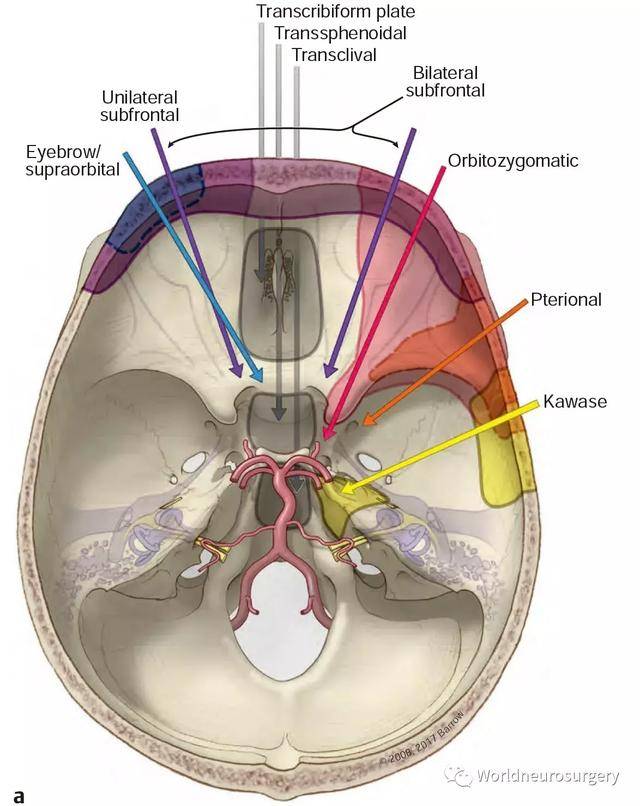 翼点入路,眶颧入路和kawase(颞下岩前入路)入路,这些入路构成了一个