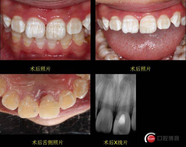 年轻恒牙外伤处理要及时