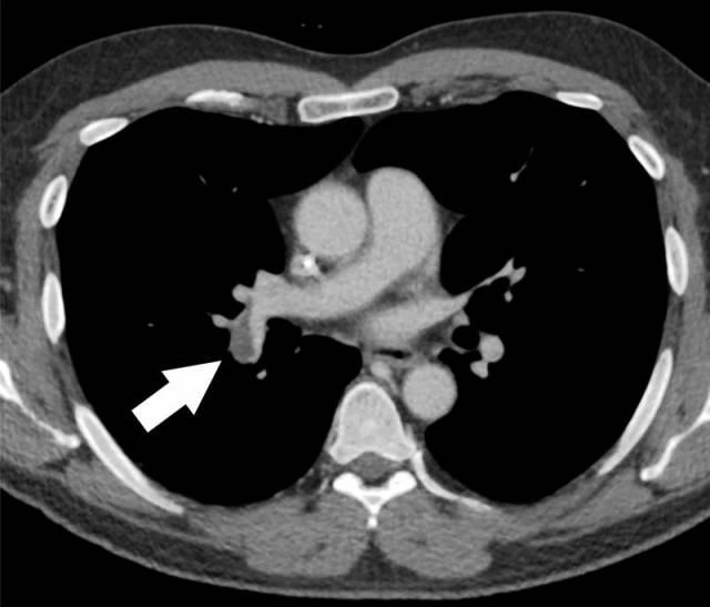 急性肺栓塞的肺ct血管造影