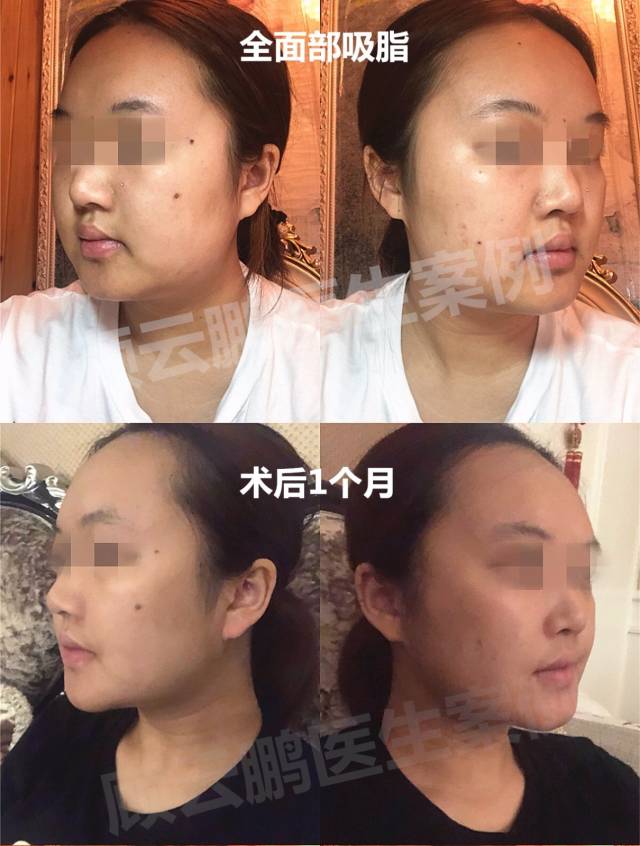 面部吸脂的常见问题与术后注意事项-内附9组案例持续更新