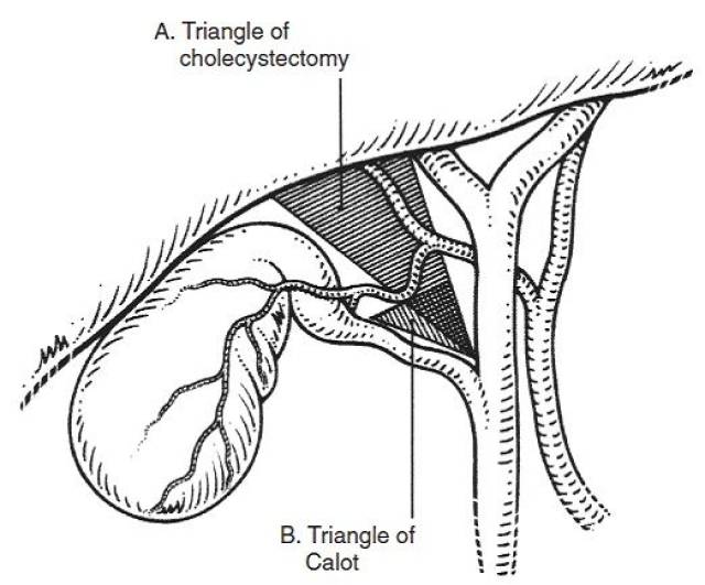 胆囊三角区示意图