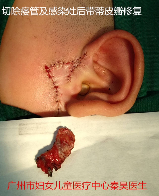 总结及心得 耳前瘘管属于常见疾病,但是持续的耳前瘘管手术难度较