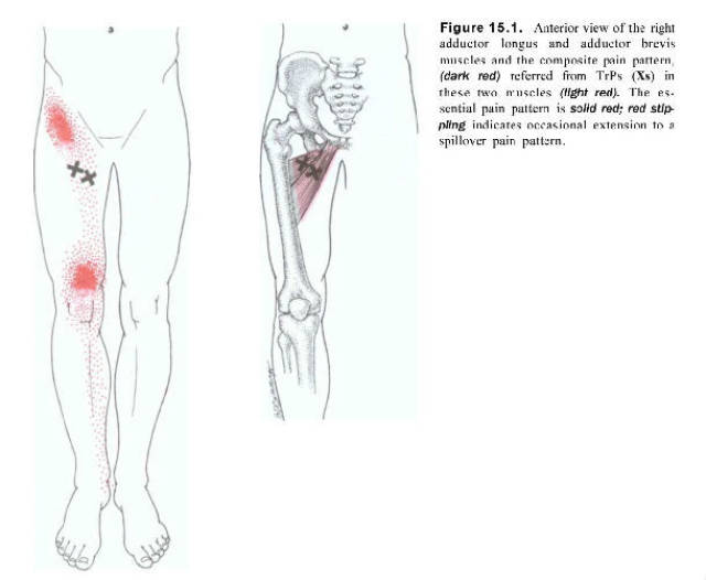 大腿内侧疼痛的肌筋膜激痛点松解治疗
