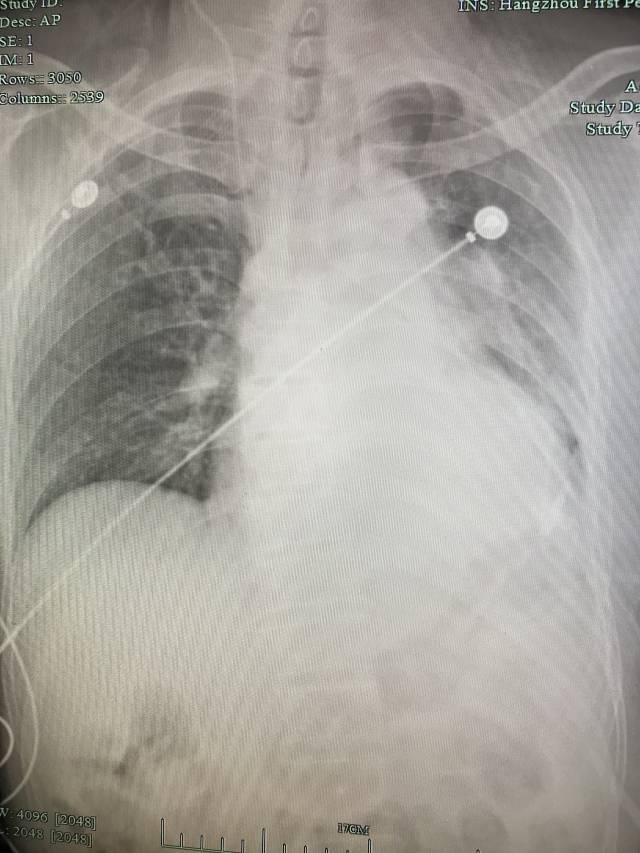 肺癌早期胸片