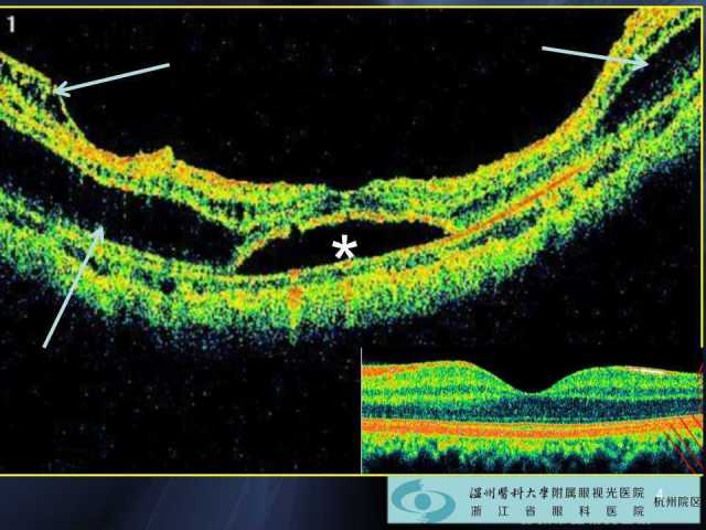 高度近视黄斑劈裂