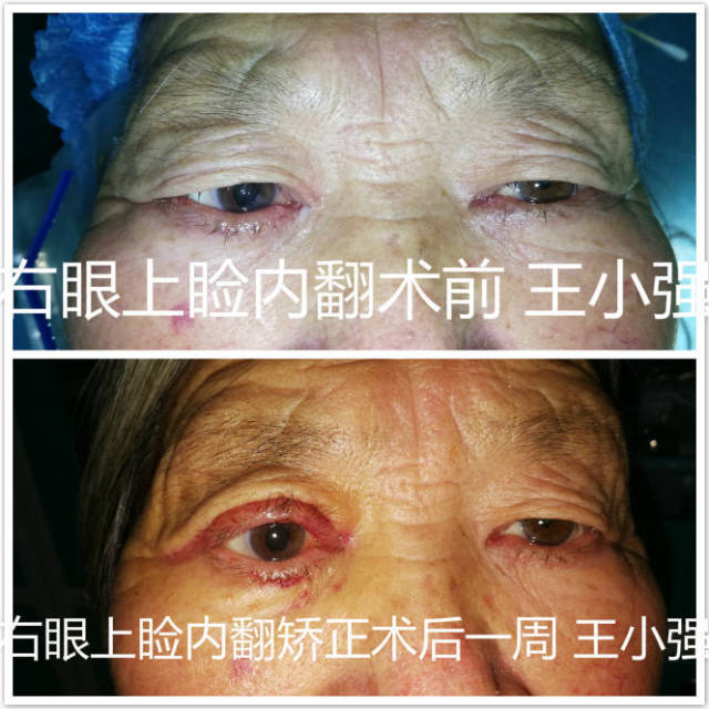 倒睫与睑内翻矫正的常见问答(附手术图片)