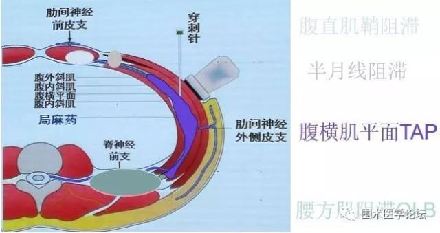 超声引导胸部及腹部阻滞