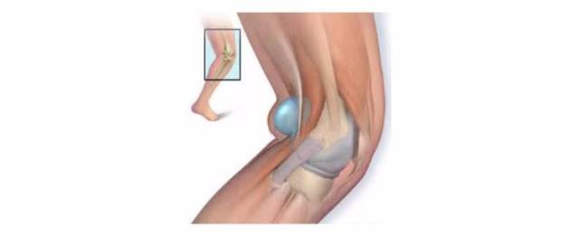 腘窝囊肿是什么回事?