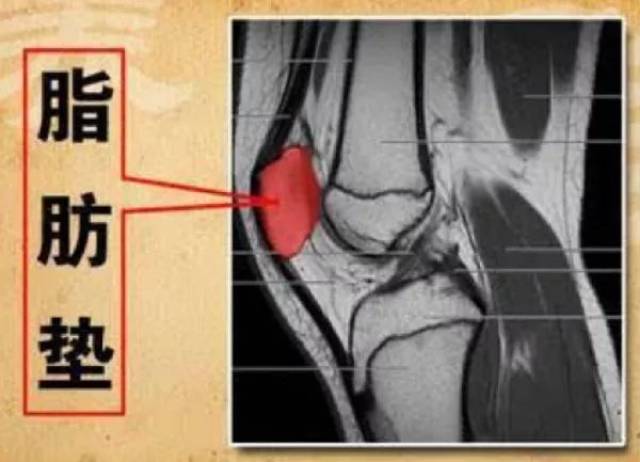 有可能是髌下脂肪垫损伤惹的祸_手机搜狐网