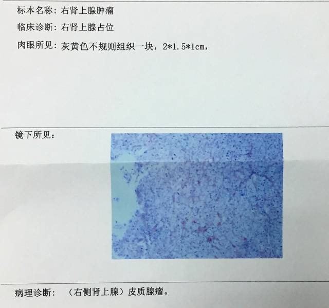 肾上腺肿瘤的手术方式和风险取决于肿瘤性质及功能