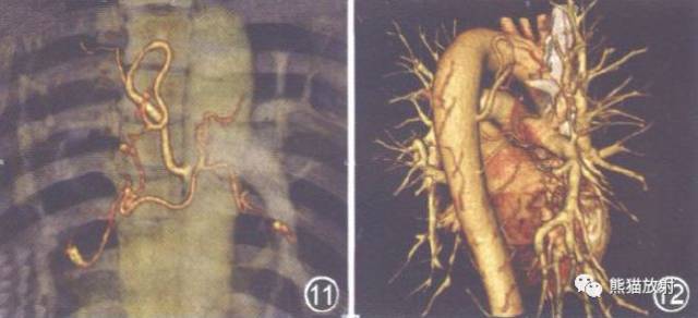 解剖丨支气管动脉cta