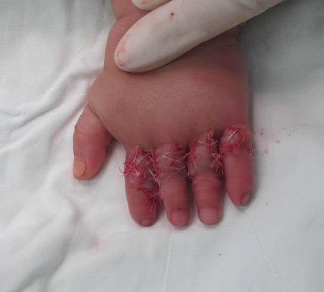 术中4个手指分离植皮后,可见指蹼弧度正常.