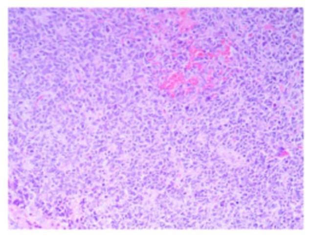 误诊为脑脓肿的成人小脑髓母细胞瘤一例---浙二