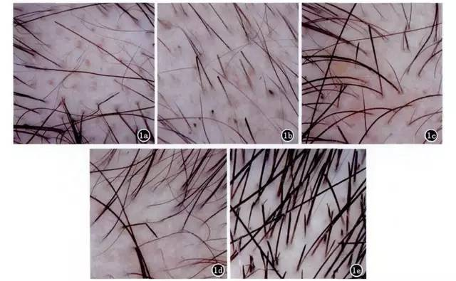 皮肤镜诊断毛发疾病 (转载)