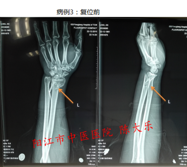 桡骨远端骨折手法复位及康复注意事项