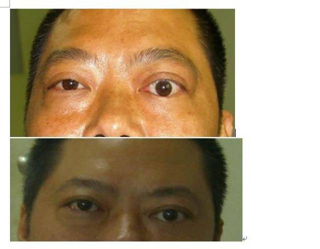 重症甲亢突眼怎么治疗?突眼典型病例治疗前后照片对照