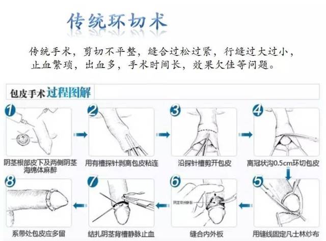 手术时间约5分钟 术中无明显痛感 切割边缘平整 可单人操作 基本无