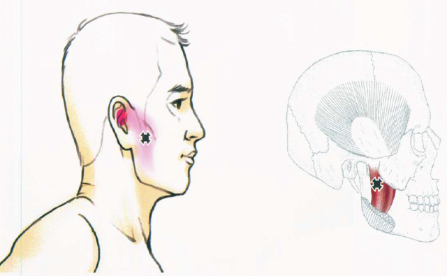 翼内肌:在口腔内按揉,颞下颌关节下方和后方,耳内深层的疼痛.