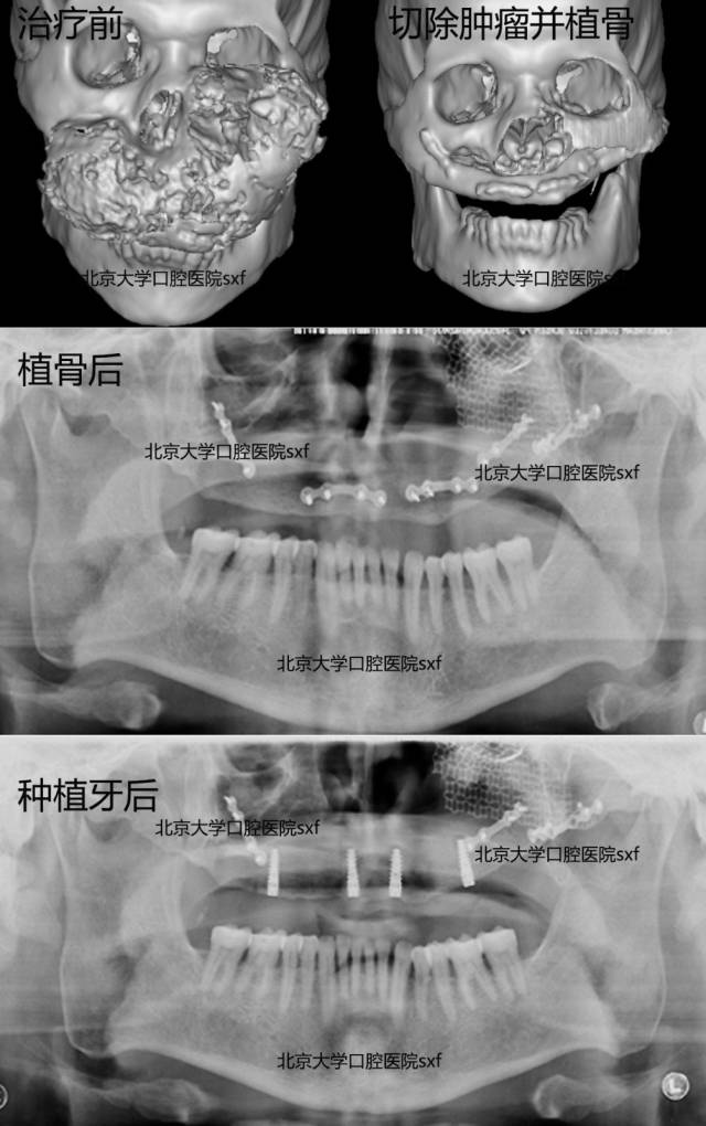 上颌骨肿瘤切除后植骨 种植牙修复病例