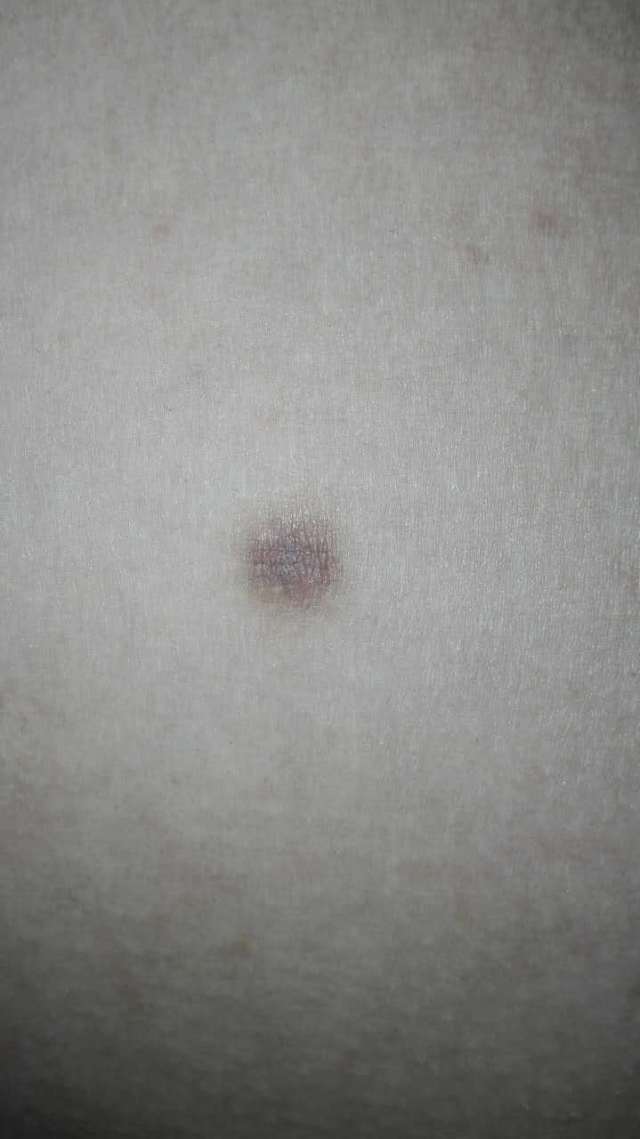 褐色坚硬小圆球,它叫皮肤纤维瘤!